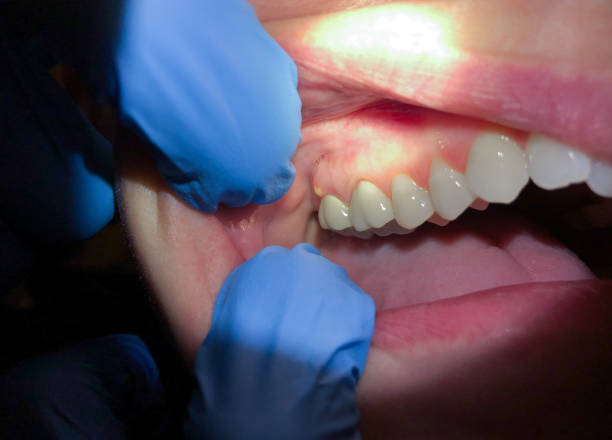 Urgent Tooth Repair in MD